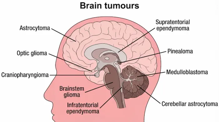 Brain Tumour Warning Signs: A Symptom Guide from Headaches to Changes